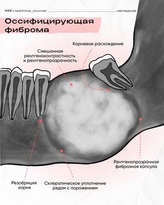 Оссифицирующая фиброма: ключевые признаки на снимке.
